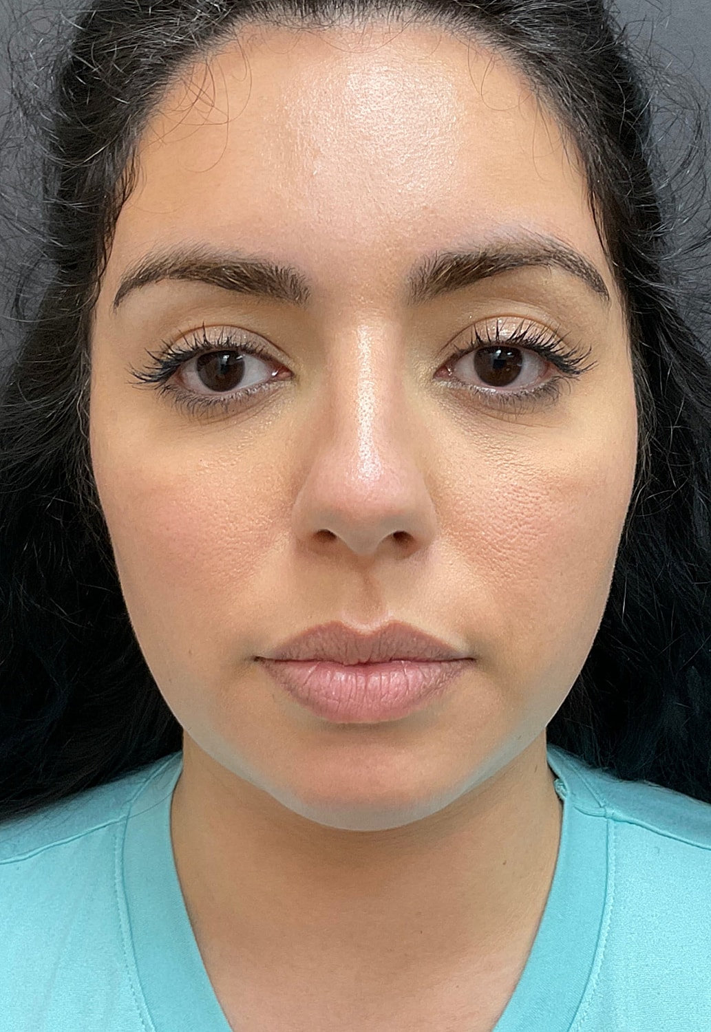 Chin Jawline Before & After