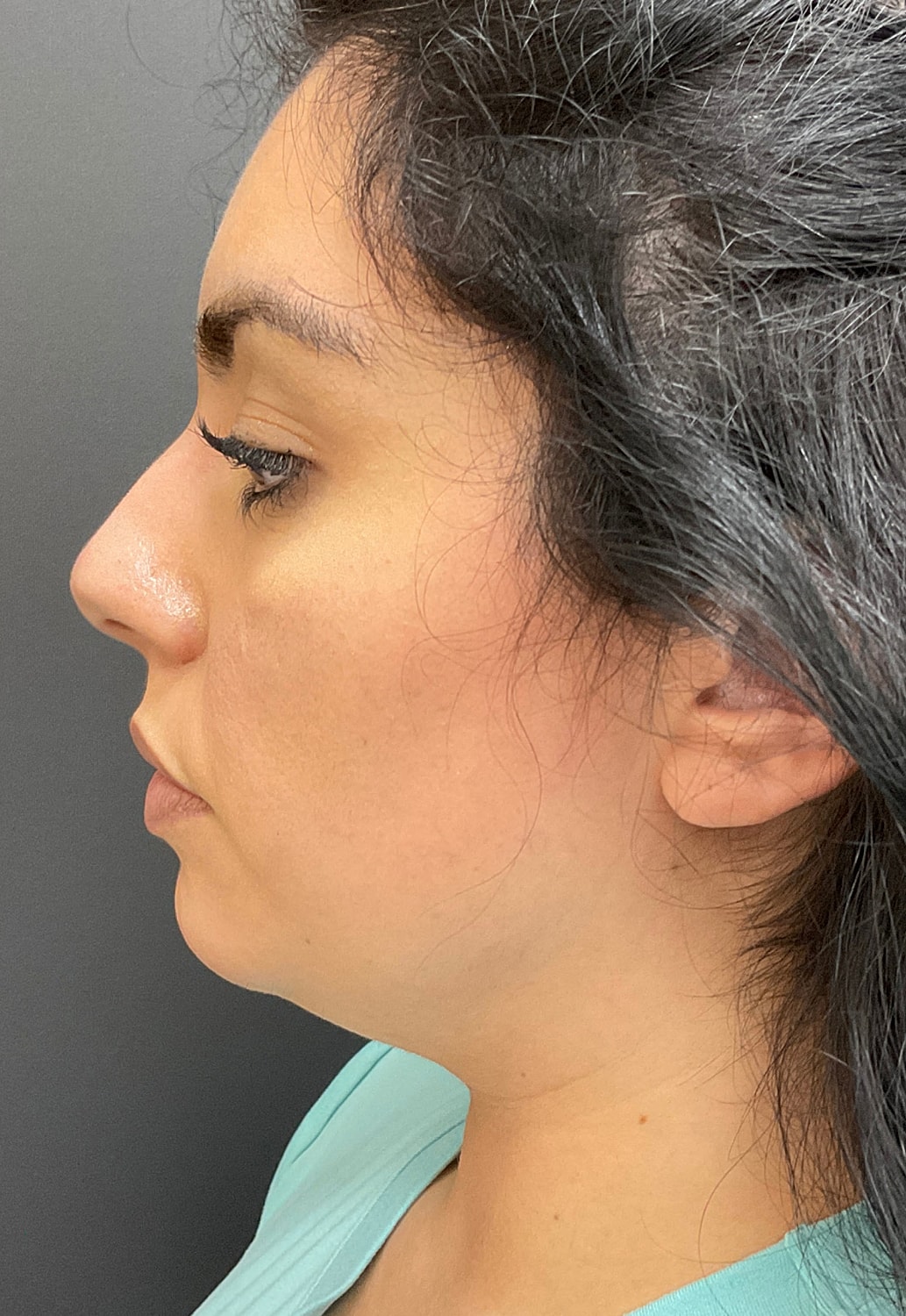 Chin Jawline Before & After