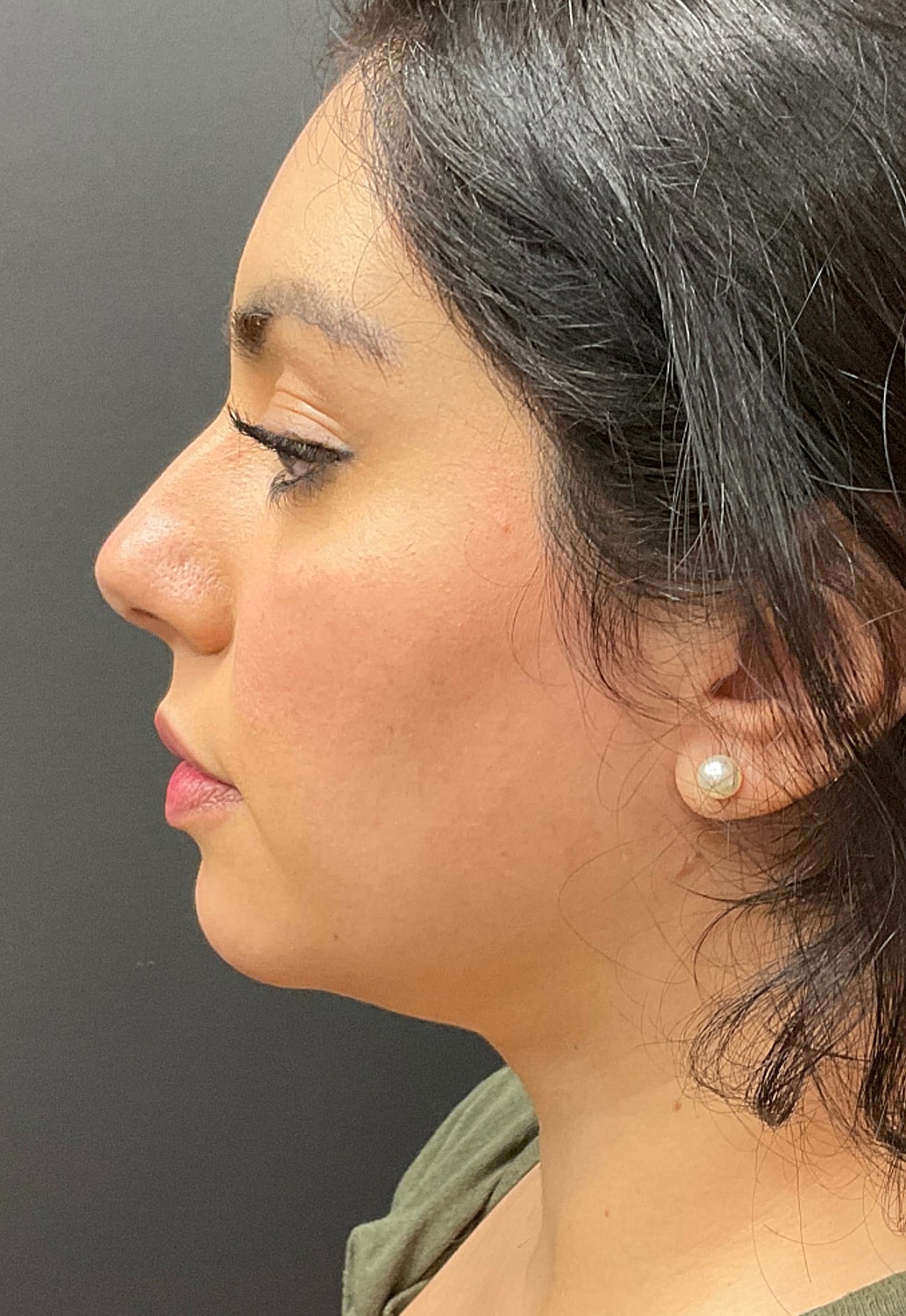 Chin Jawline Before & After