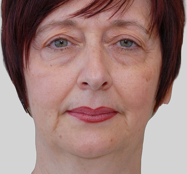 Chin Jawline Before & After