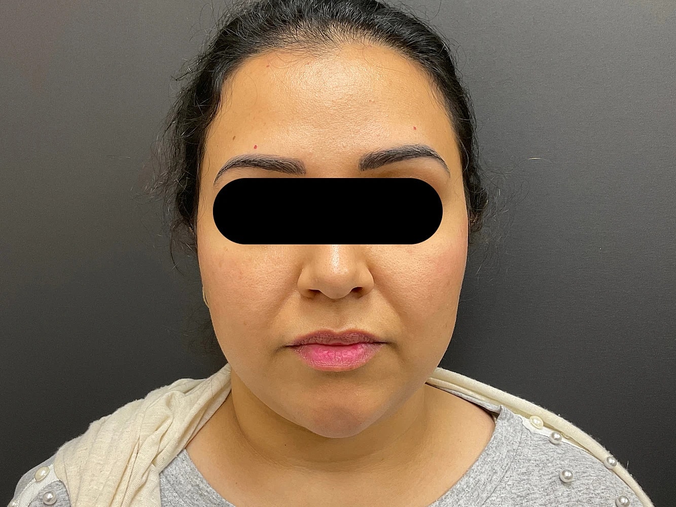 Chin Jawline Before & After