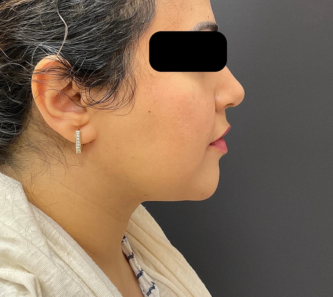 Chin Jawline Before & After