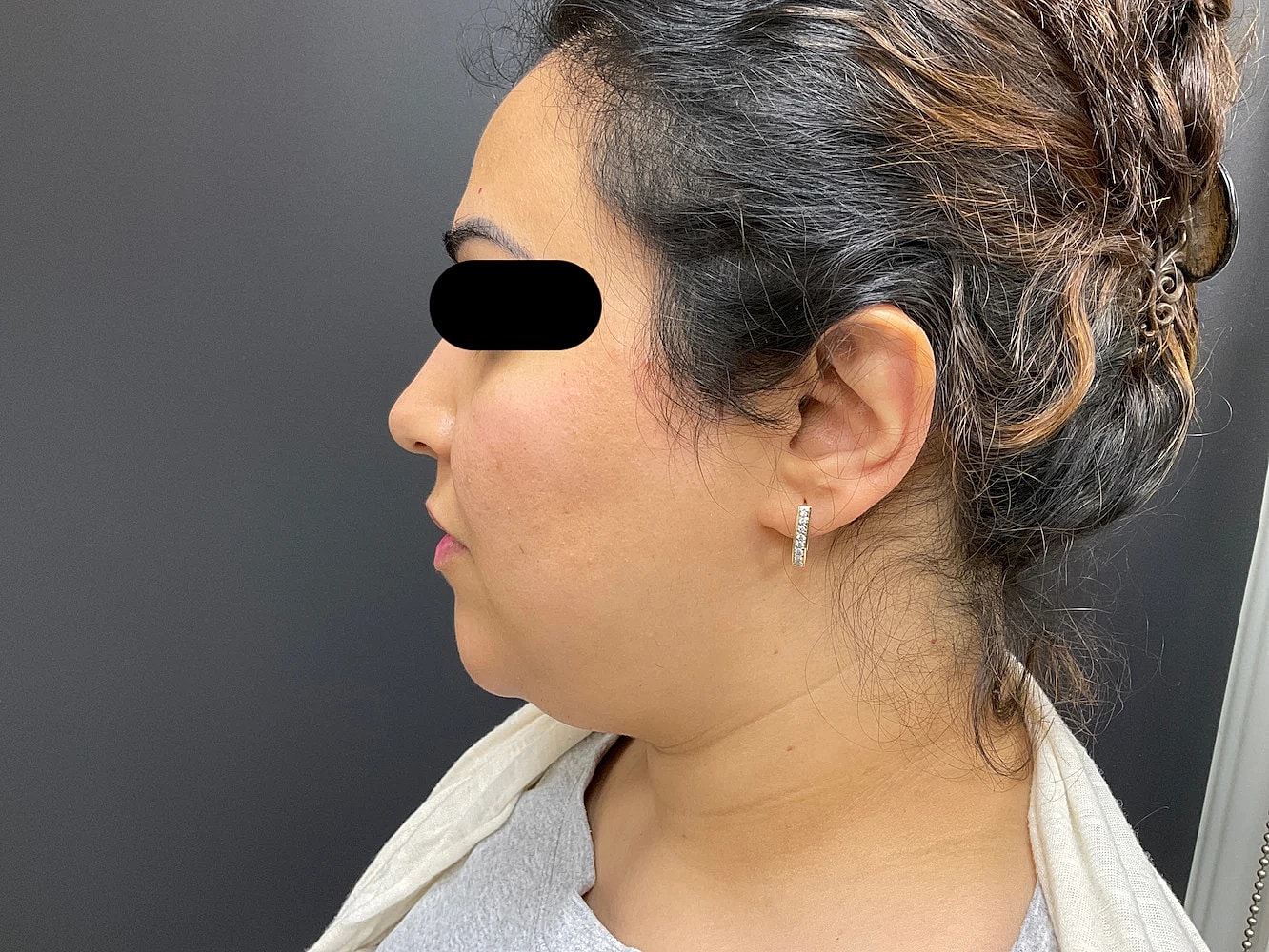 Chin Jawline Before & After