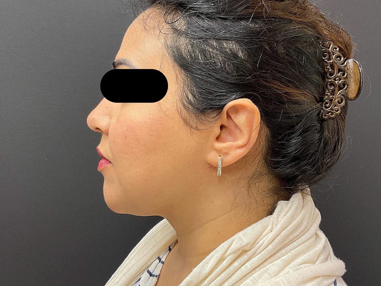 Chin Jawline Before & After