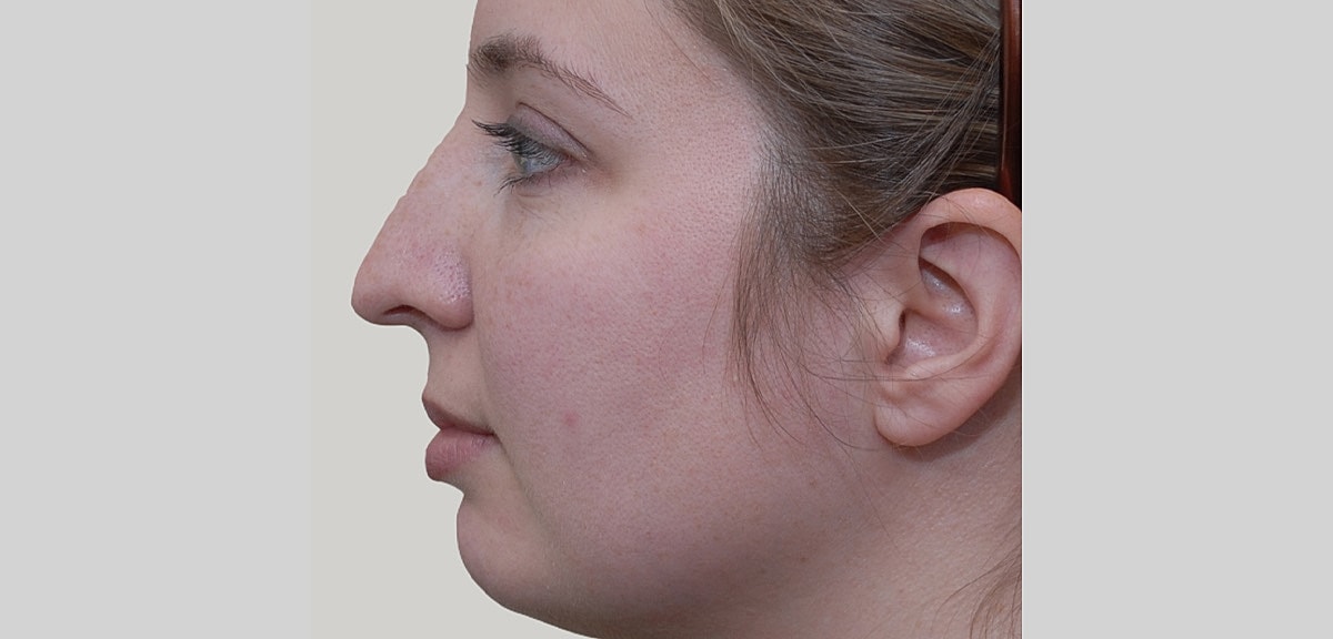 Chin Jawline Before & After