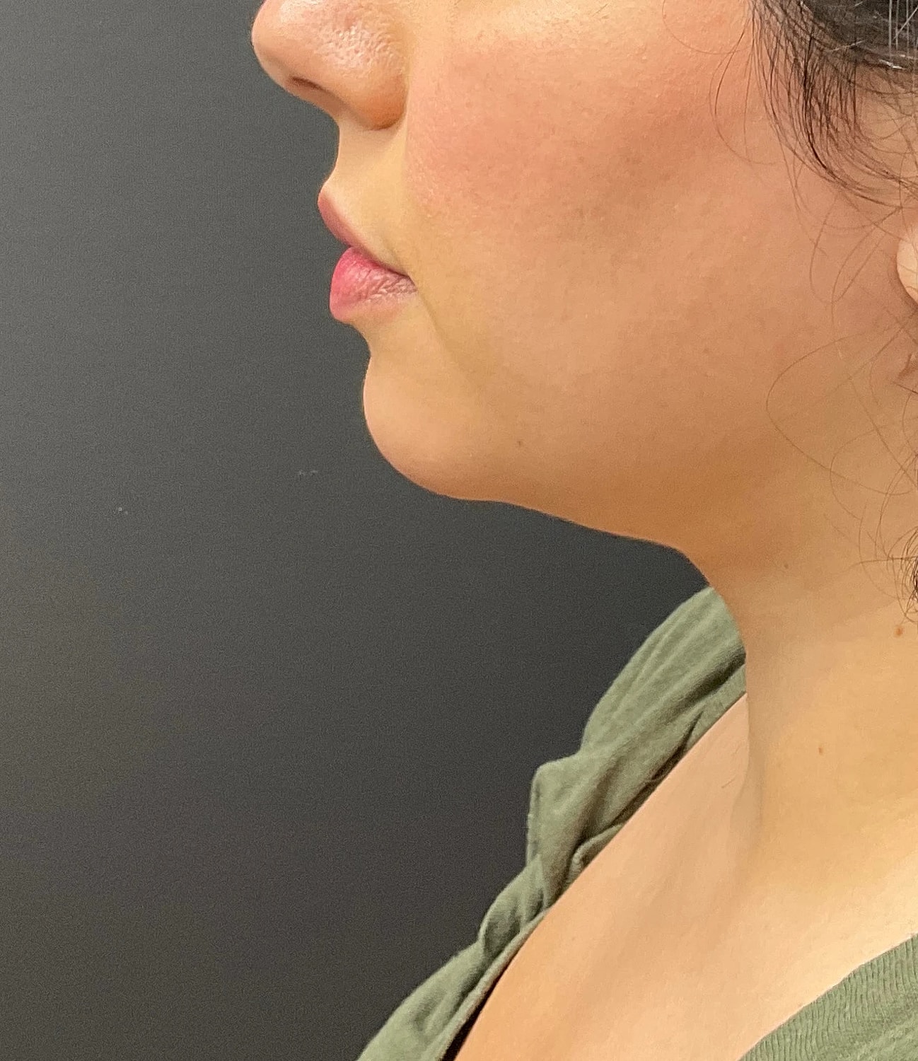 Chin Jawline Before & After