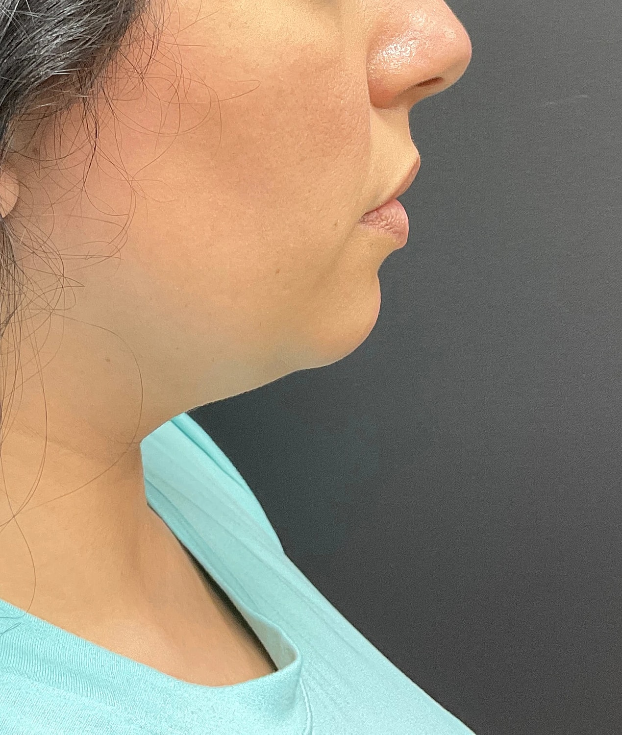 Chin Jawline Before & After