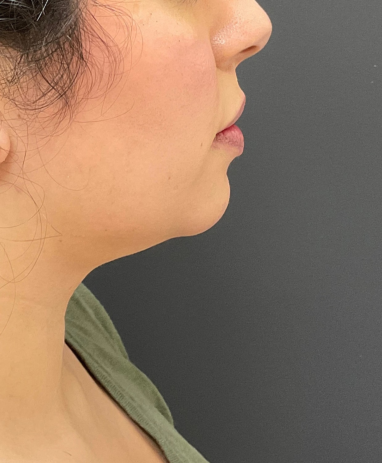 Chin Jawline Before & After