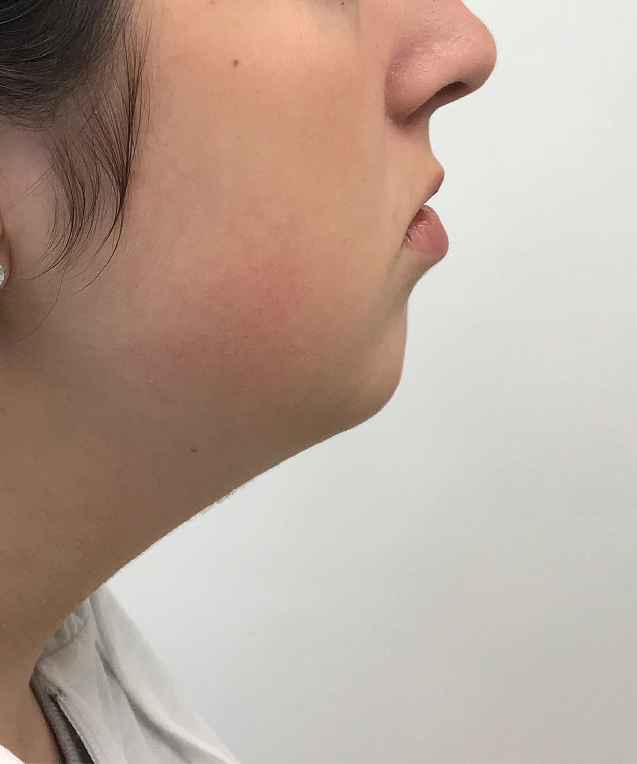 Chin Jawline Before & After