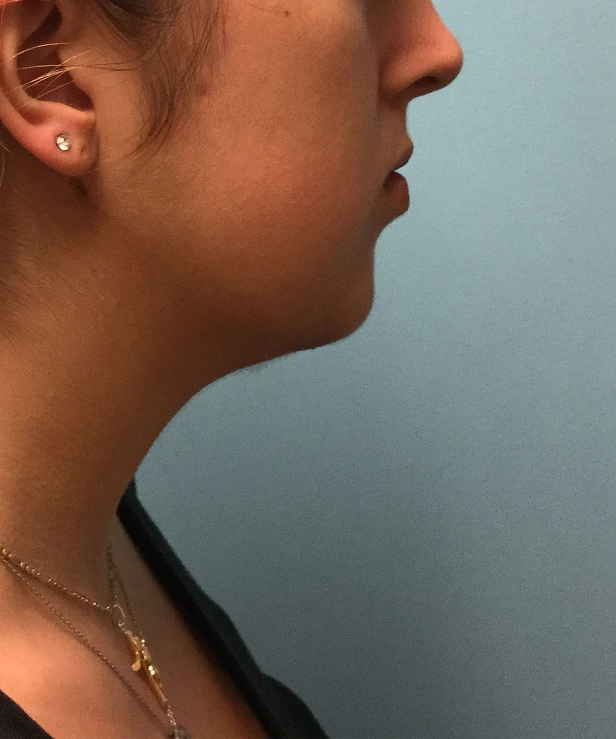 Chin Jawline Before & After
