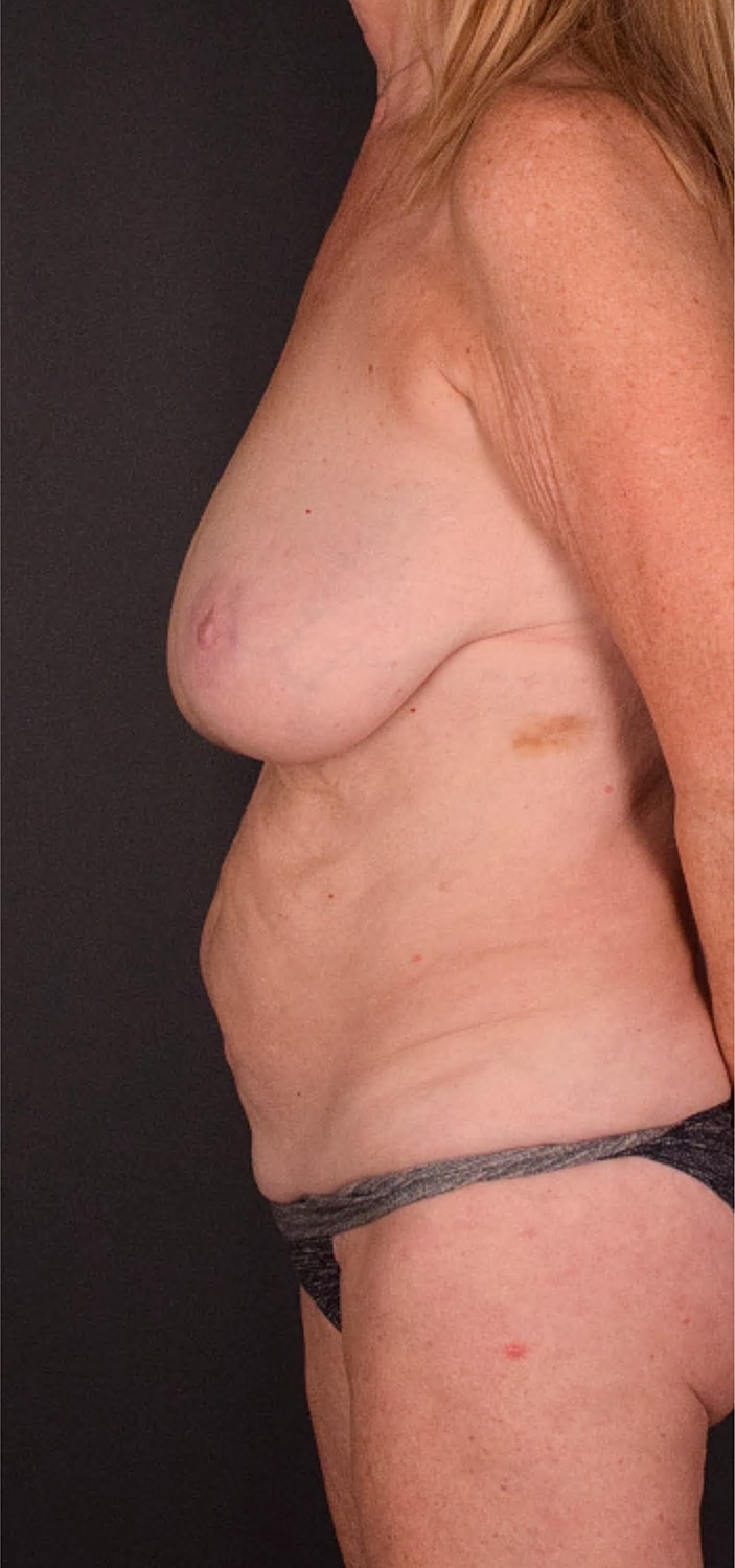 Breast Reduction Before & After