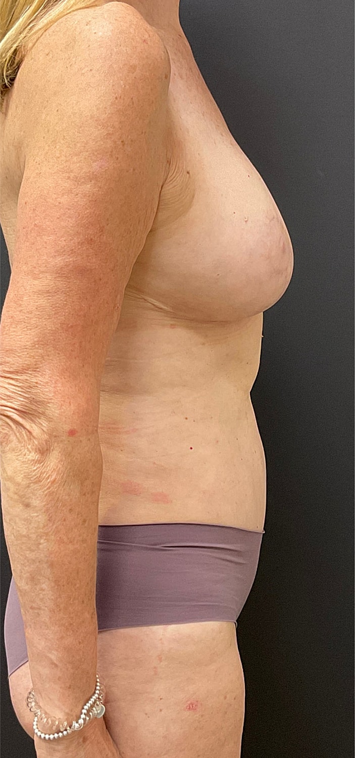 Breast Reduction Before & After