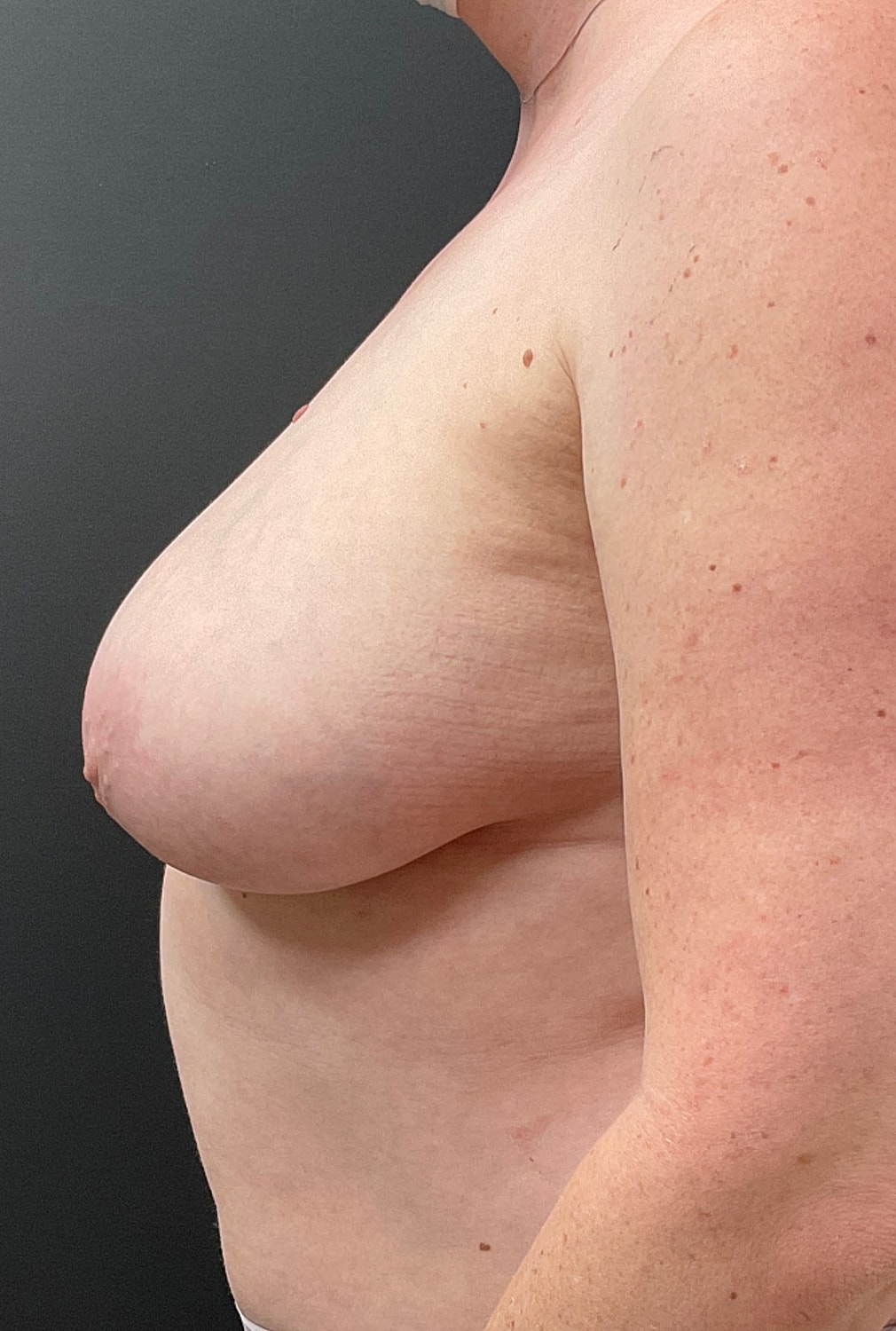 Breast Reduction Before & After