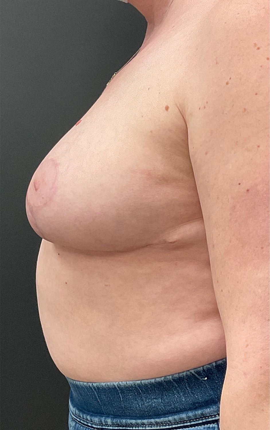 Breast Reduction Before & After