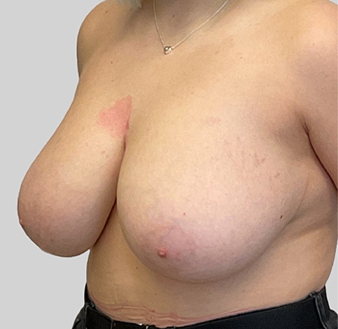 Breast Reduction Before & After