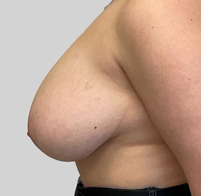 Breast Reduction Before & After