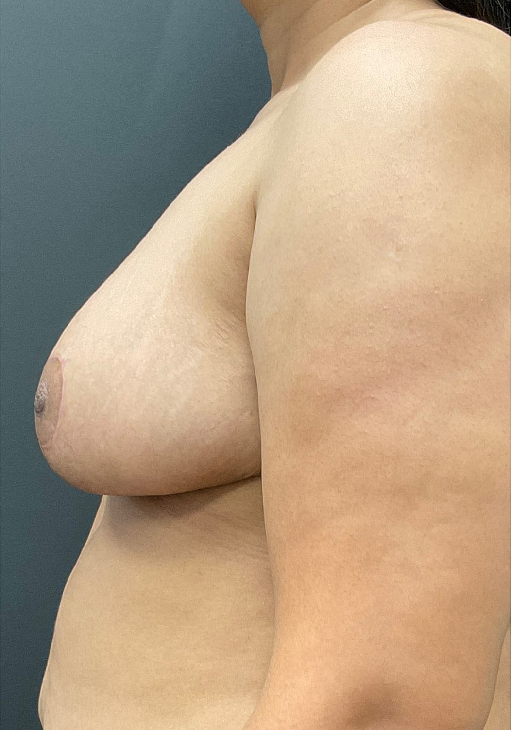 Breast Reduction Before & After