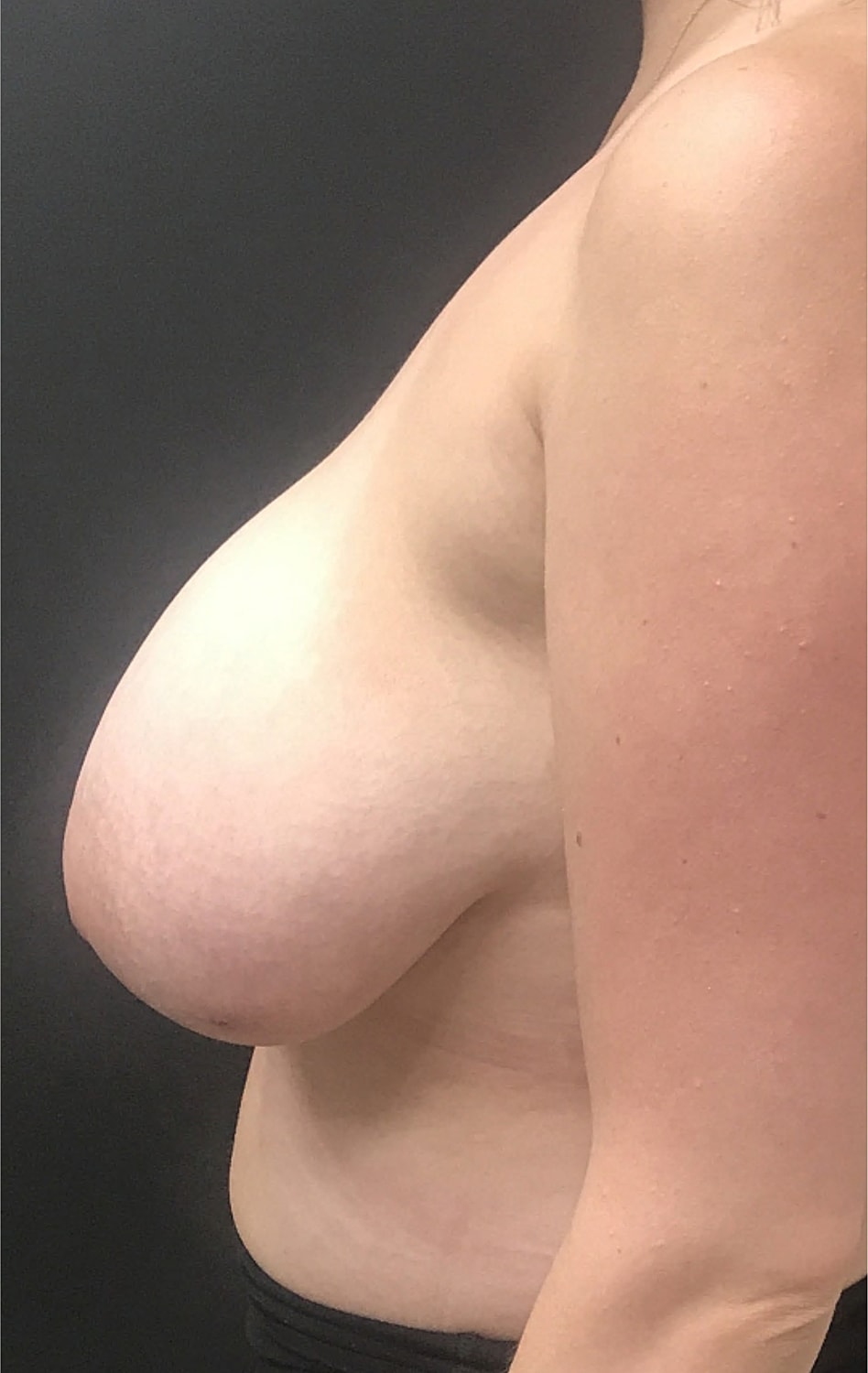 Breast Reduction Before & After