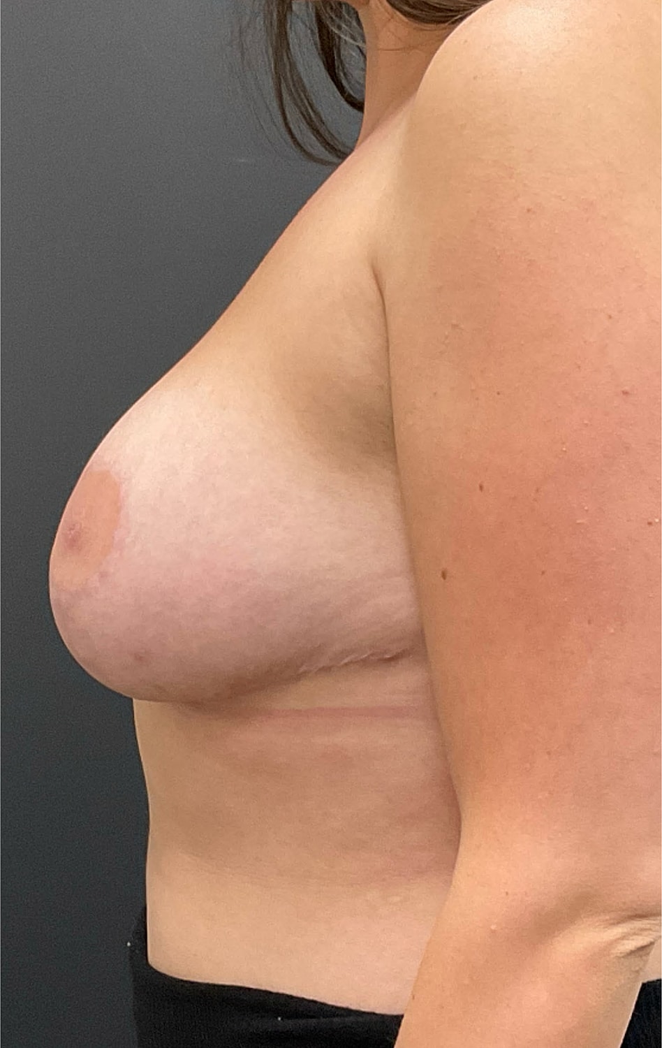 Breast Reduction Before & After