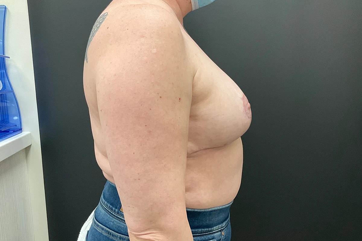 Breast Reduction Before & After