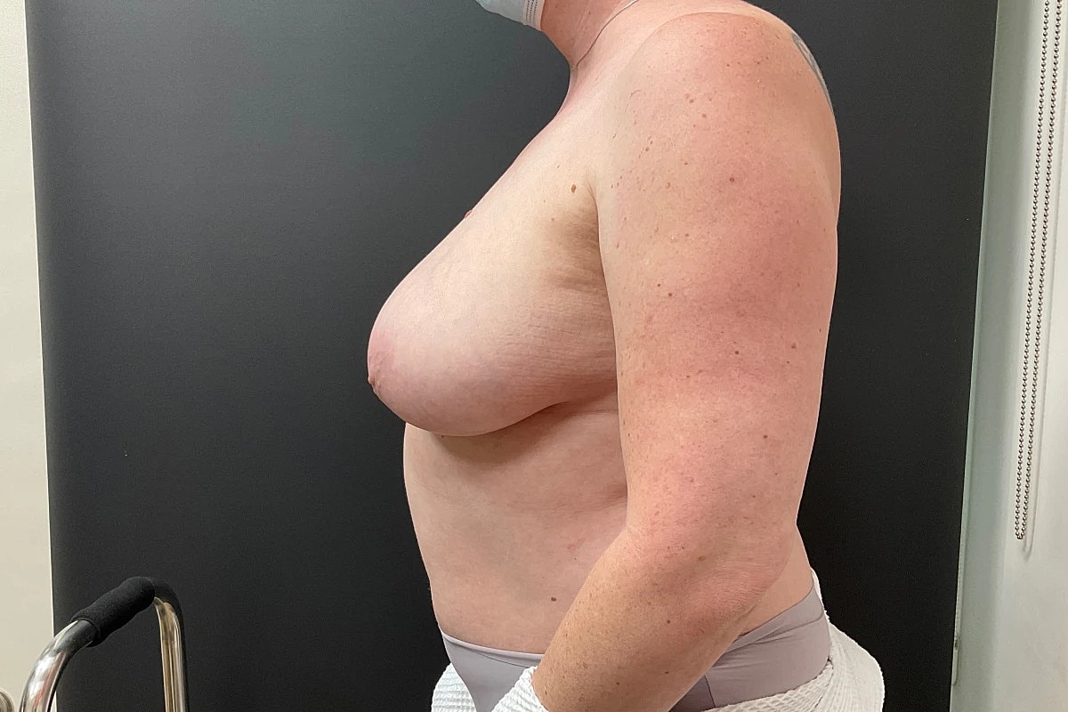 Breast Reduction Before & After