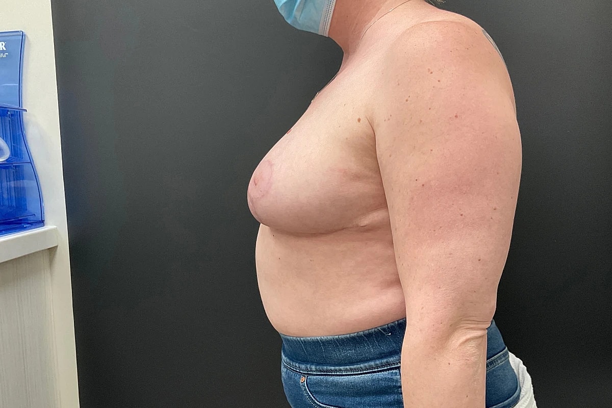 Breast Reduction Before & After