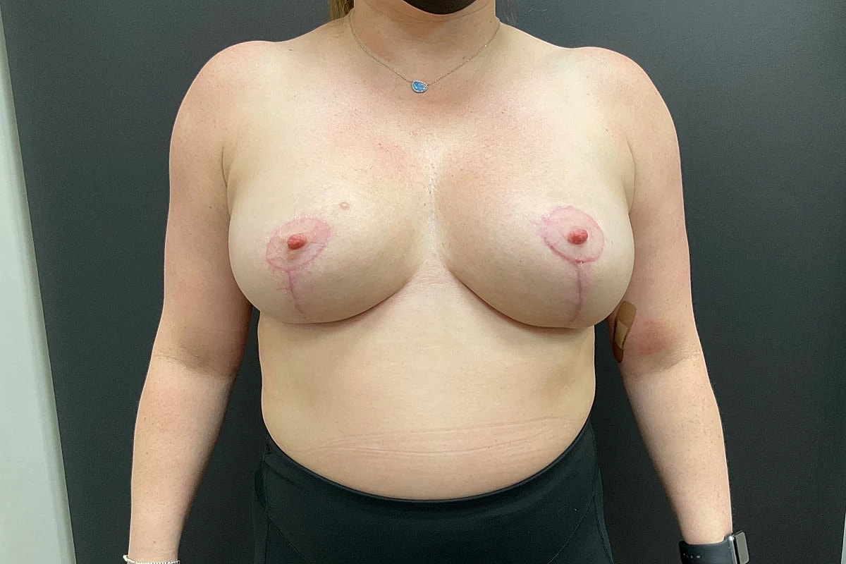 Breast Reduction Before & After