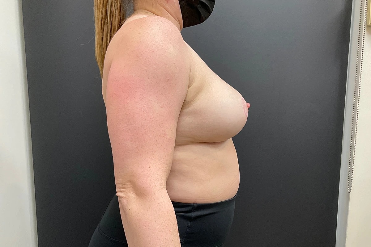 Breast Reduction Before & After