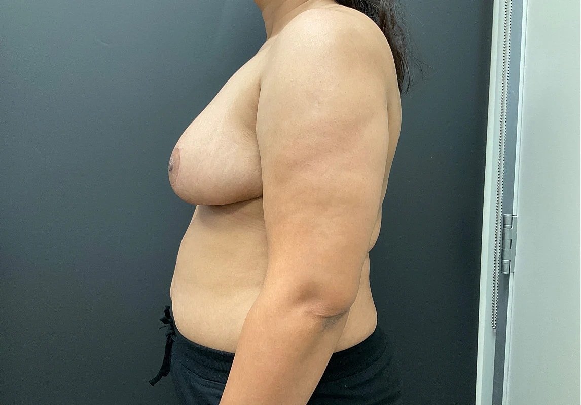 Breast Reduction Before & After
