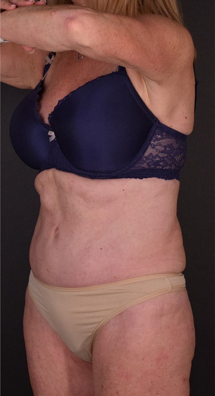 Mommy Makeover Before & After