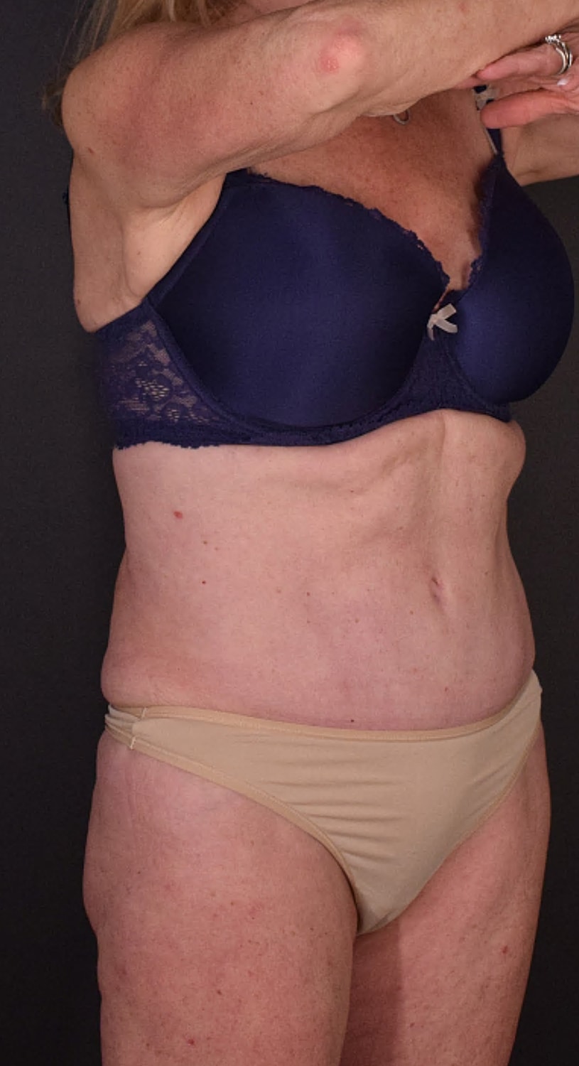 Mommy Makeover Before & After