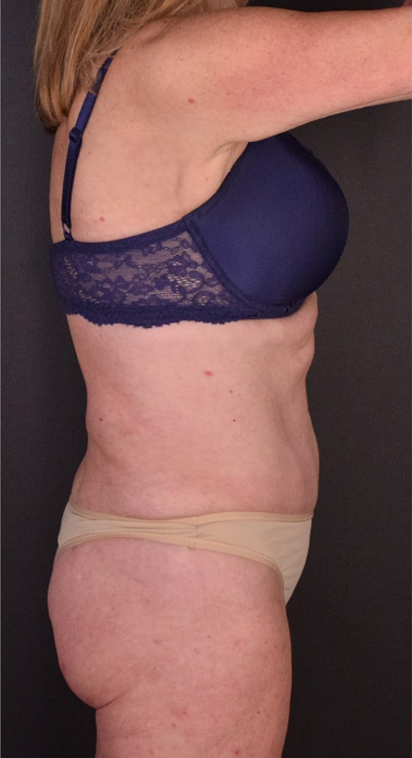 Mommy Makeover Before & After