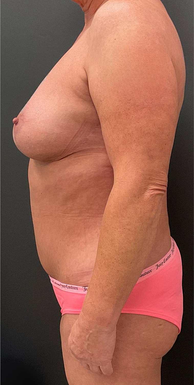 Mommy Makeover Before & After