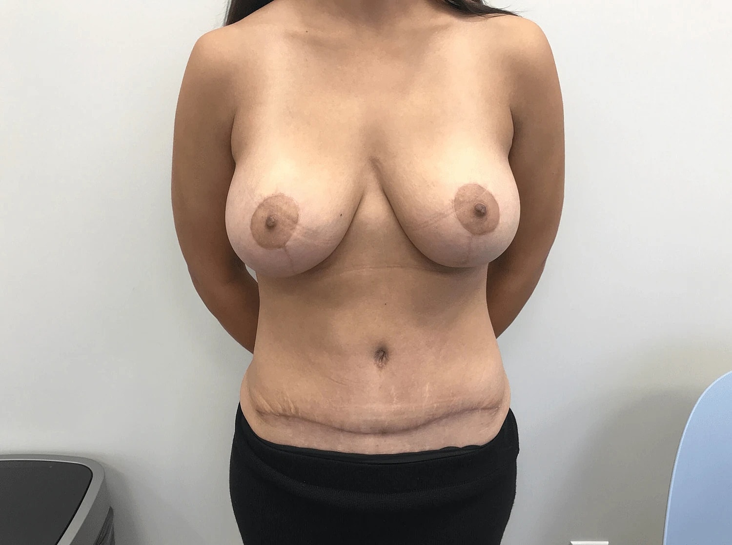 Mommy Makeover Before & After