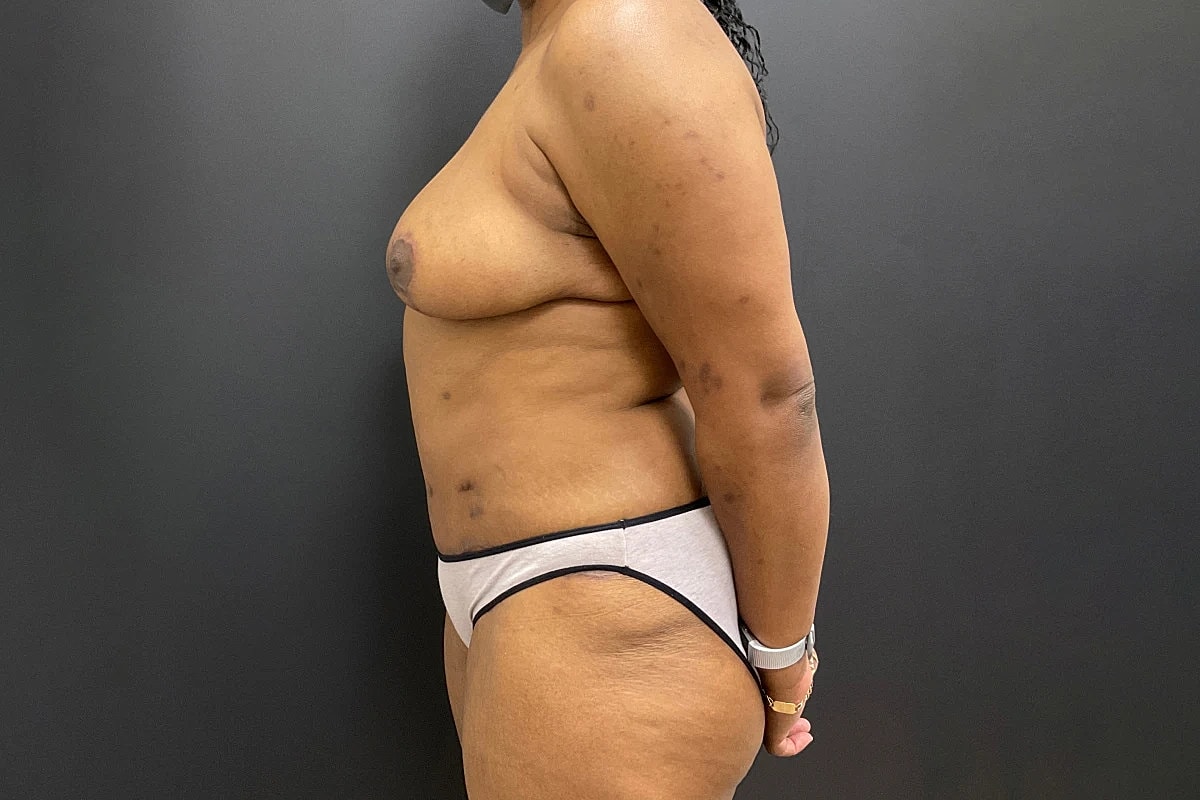 Mommy Makeover Before & After