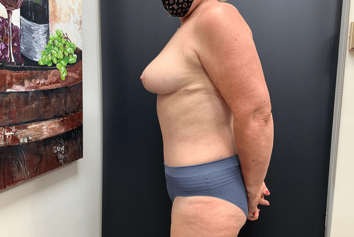 Mommy Makeover Before & After