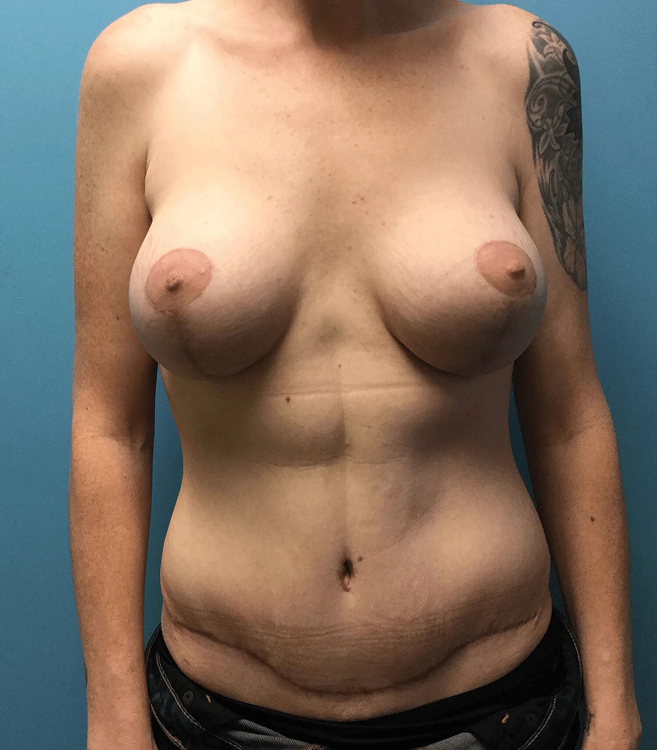 Mommy Makeover Before & After