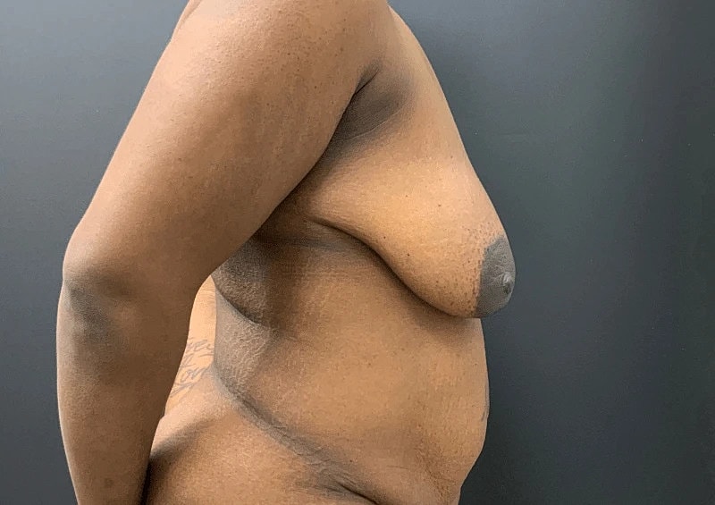 Breast Augmentation Lift Before & After