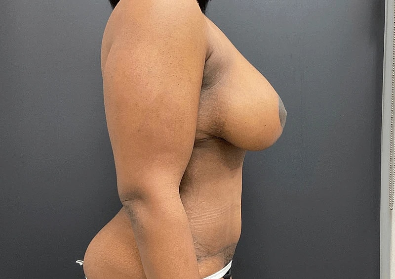 Breast Augmentation Lift Before & After