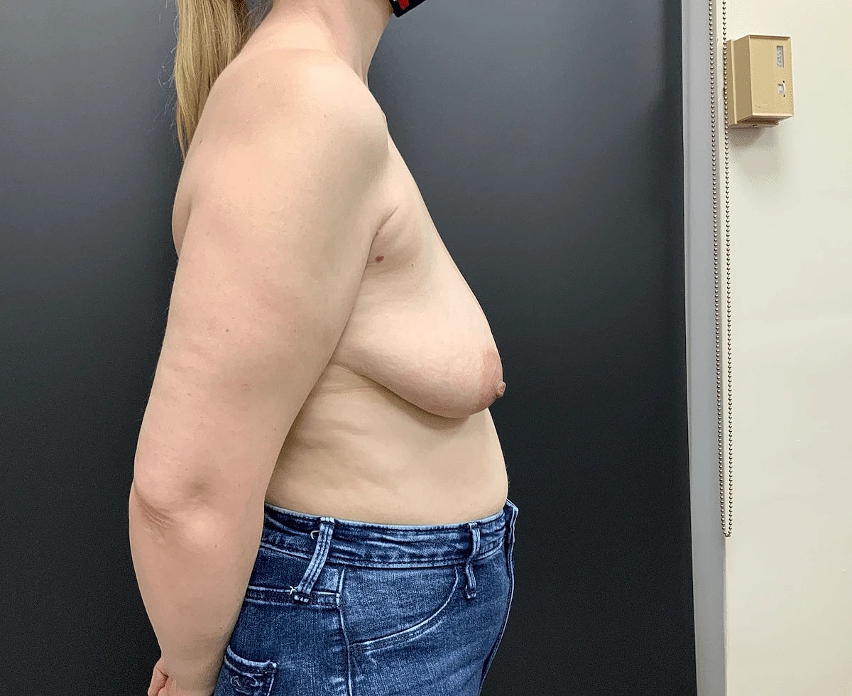 Breast Augmentation Lift Before & After