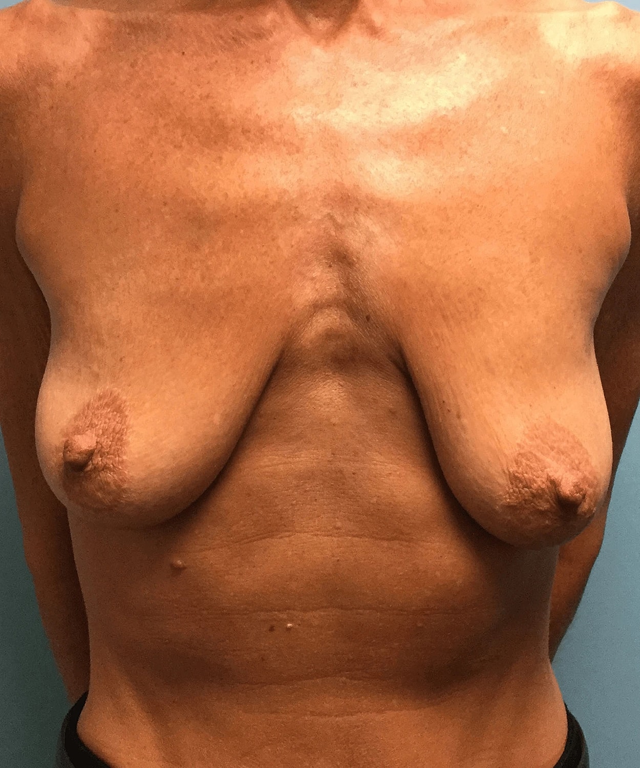 Breast Augmentation Lift Before & After