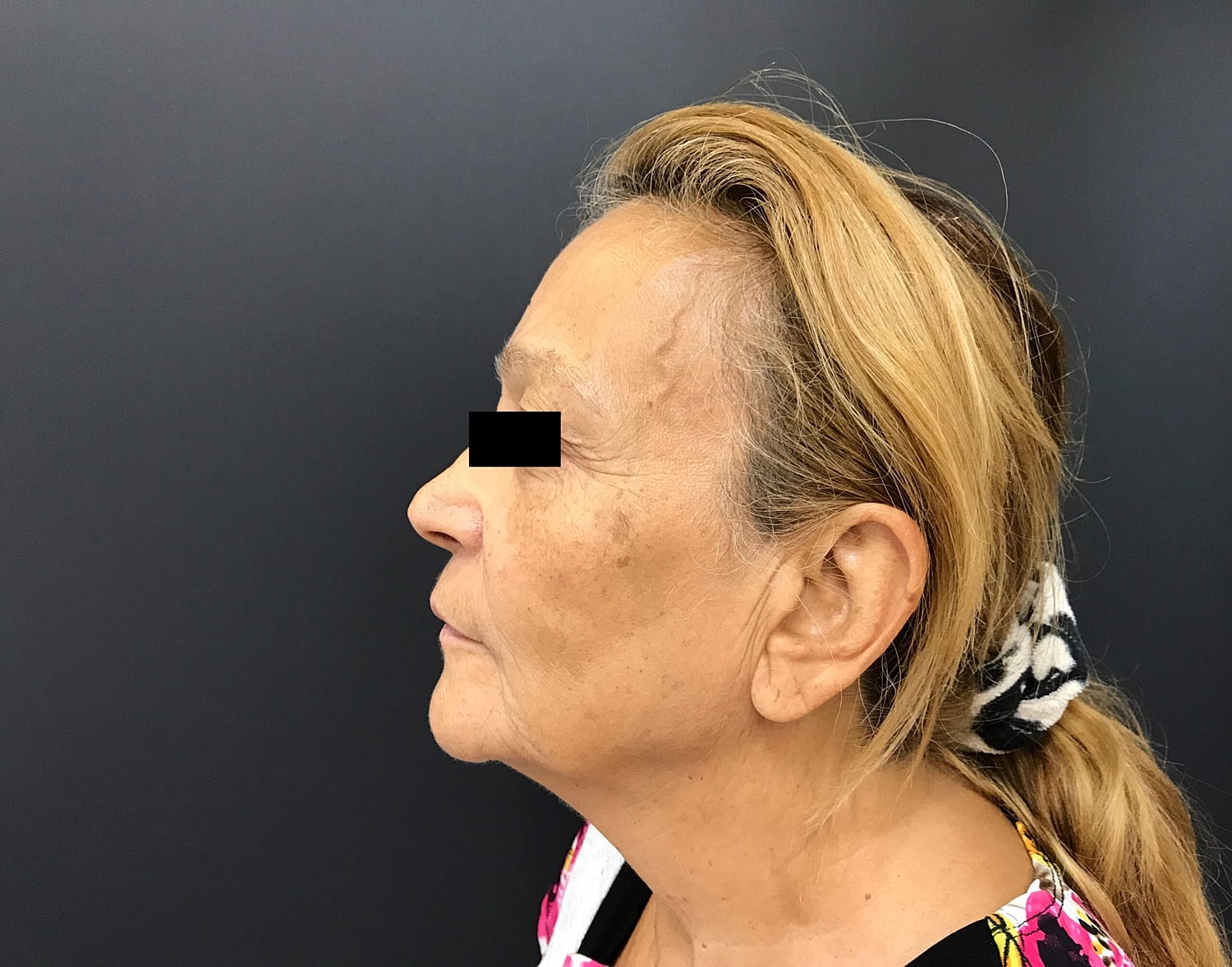 Venus Tribella Before & After