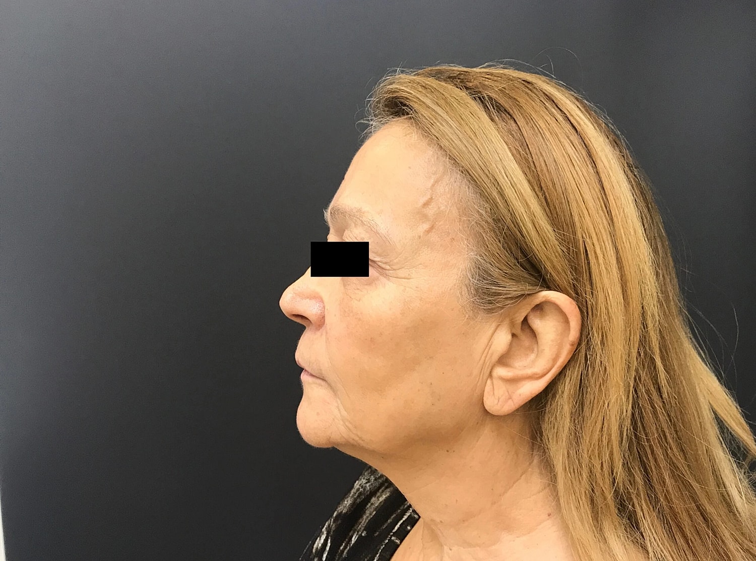Venus Tribella Before & After