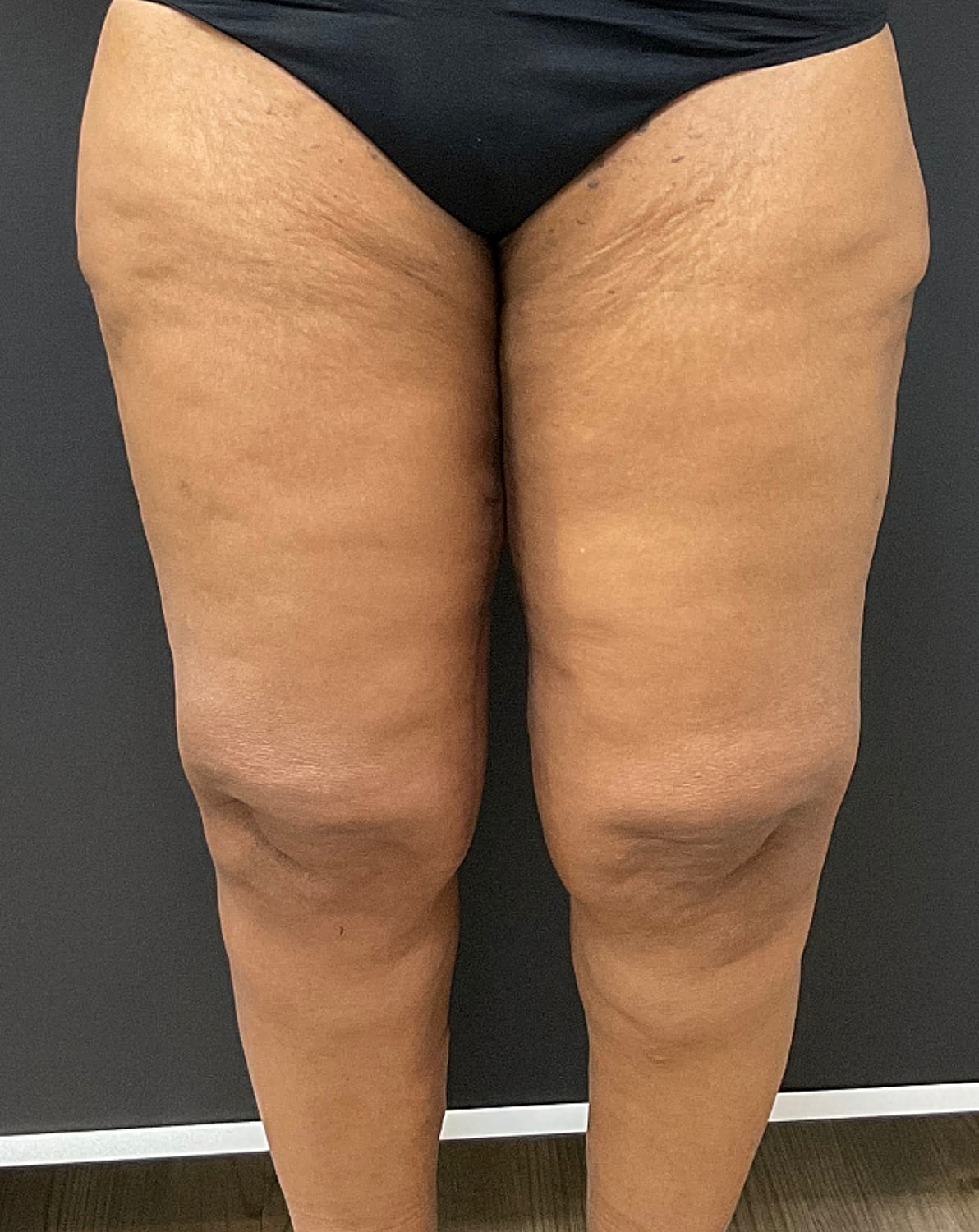 Arm Lift Thigh Lift Before & After