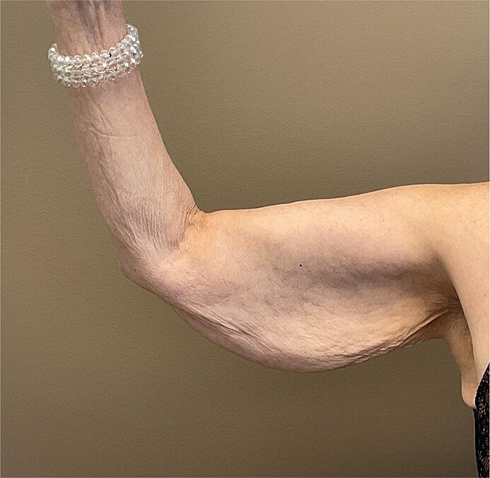 Arm Lift Thigh Lift Before & After