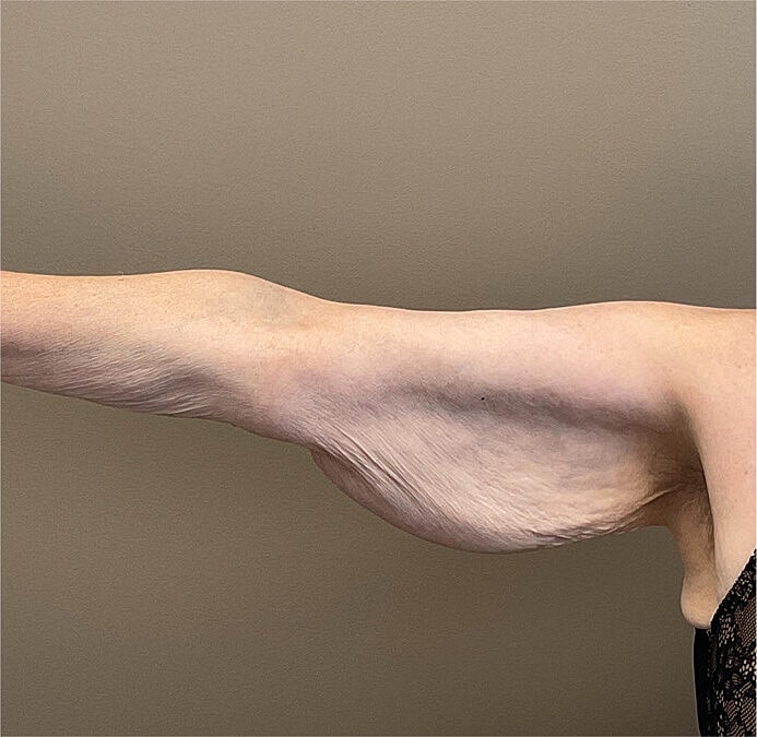 Arm Lift Thigh Lift Before & After