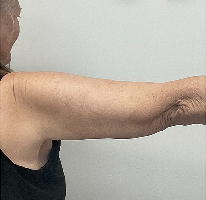 Arm Lift Thigh Lift Before & After