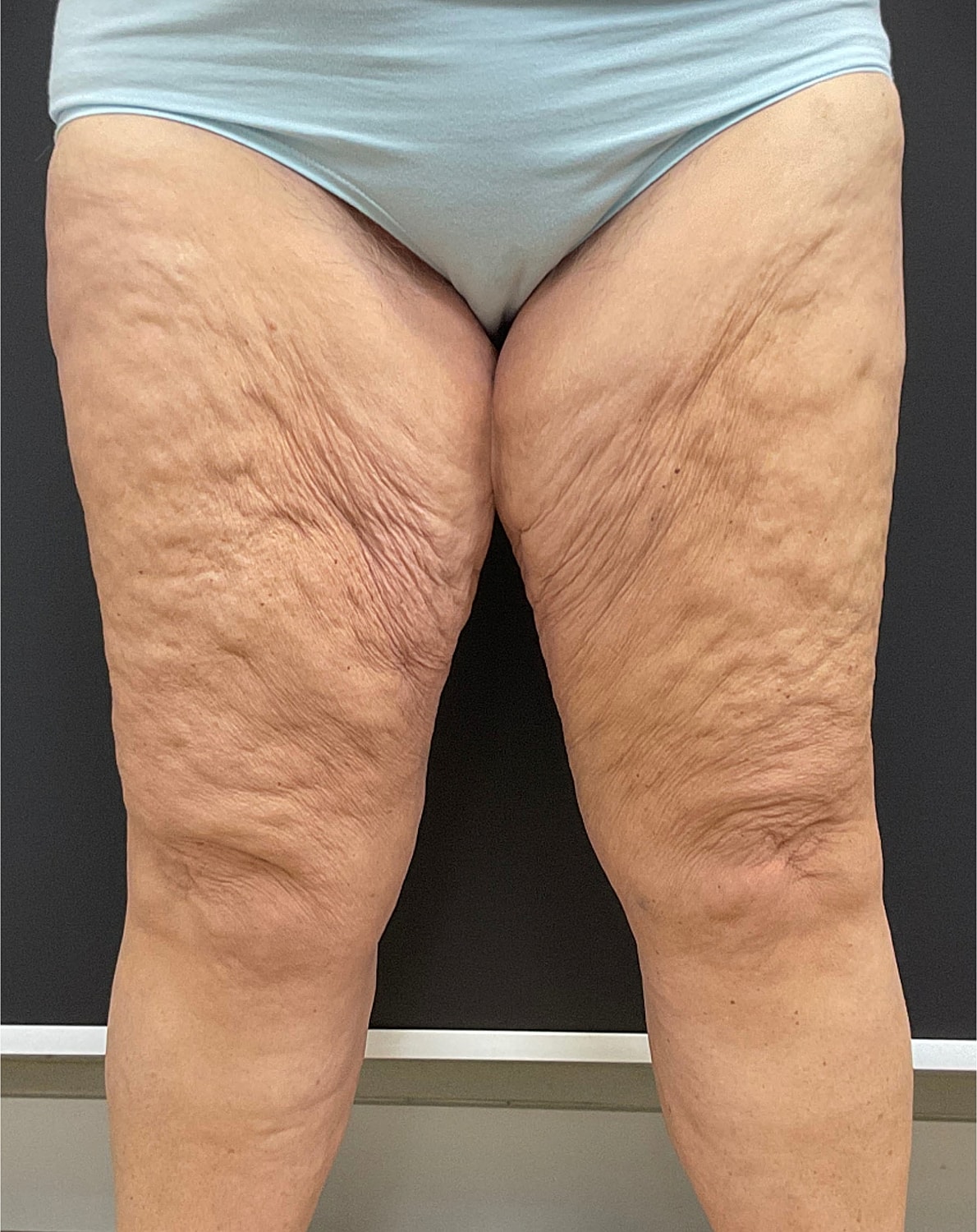 Arm Lift Thigh Lift Before & After