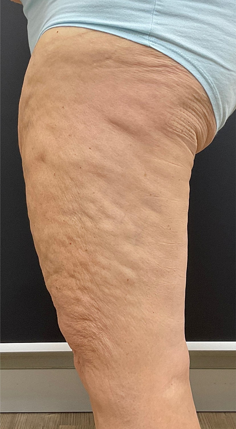Arm Lift Thigh Lift Before & After