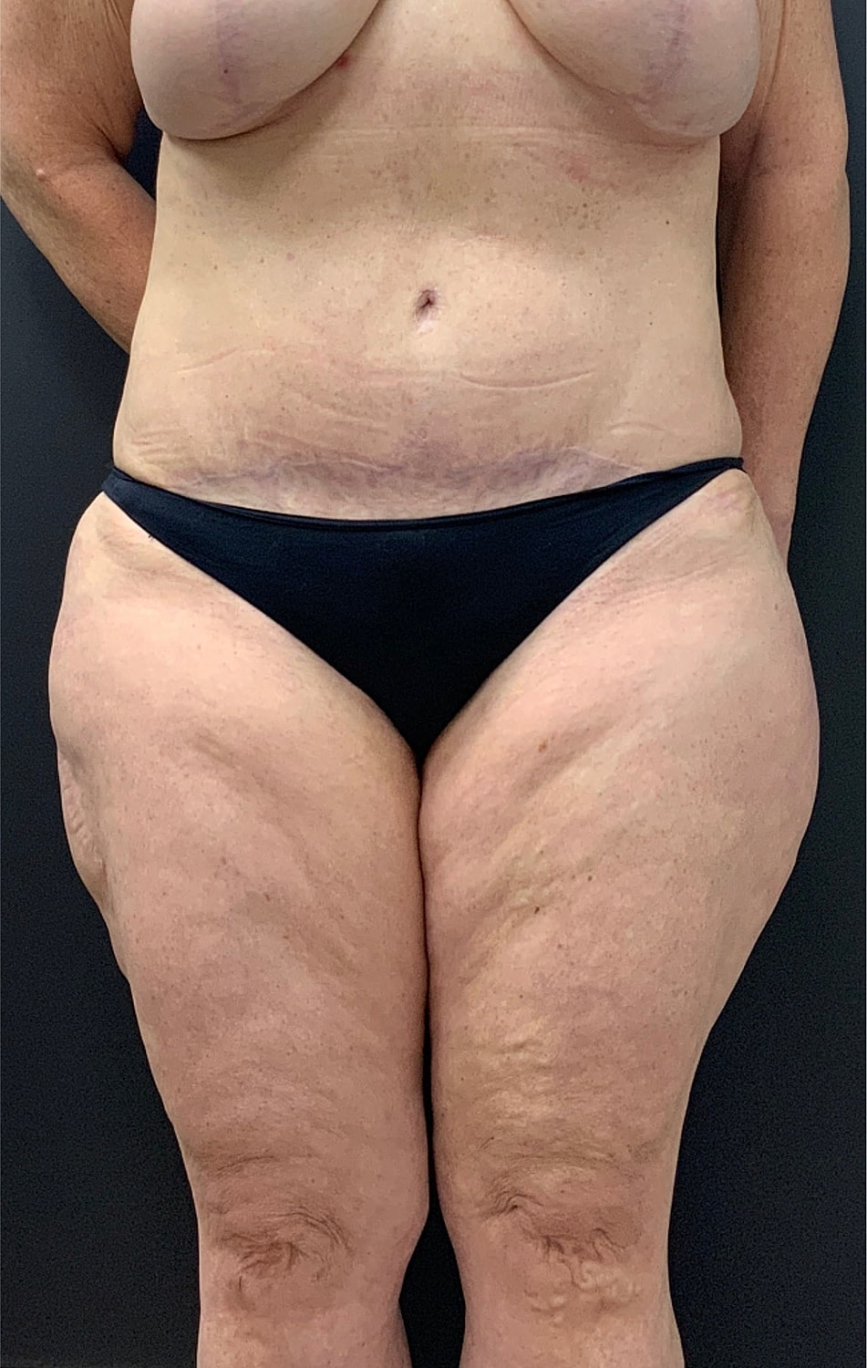 Arm Lift Thigh Lift Before & After